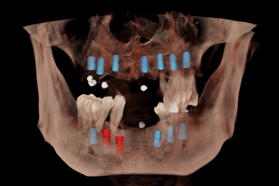 Temporary Teeth After Implants in Songpa-dong: Why They Can Be Provided Quickly image 4