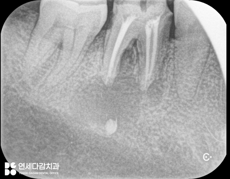 신경치료 후 크라운 떨어짐 원인으로 감염된 충치 치료 미루다 잇몸뼈 녹음 증상 개롱역 치과 발치 후 치근단 낭 적출술 관련 이미지 1