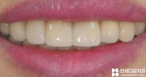 앞니 레진 후 생긴 변색 문제와 삐뚤어진 치아 개롱역 치과 최소삭제 라미네이트 적용할 수 있는 이유 관련 이미지 12