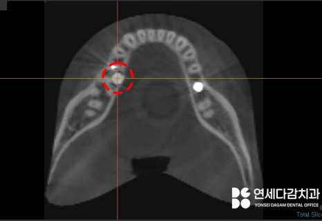 매복과잉치 를 발치할 때 CT 촬영이 필요한 이유? 연세다감치과 의학 정보 전달 글 관련 이미지 5