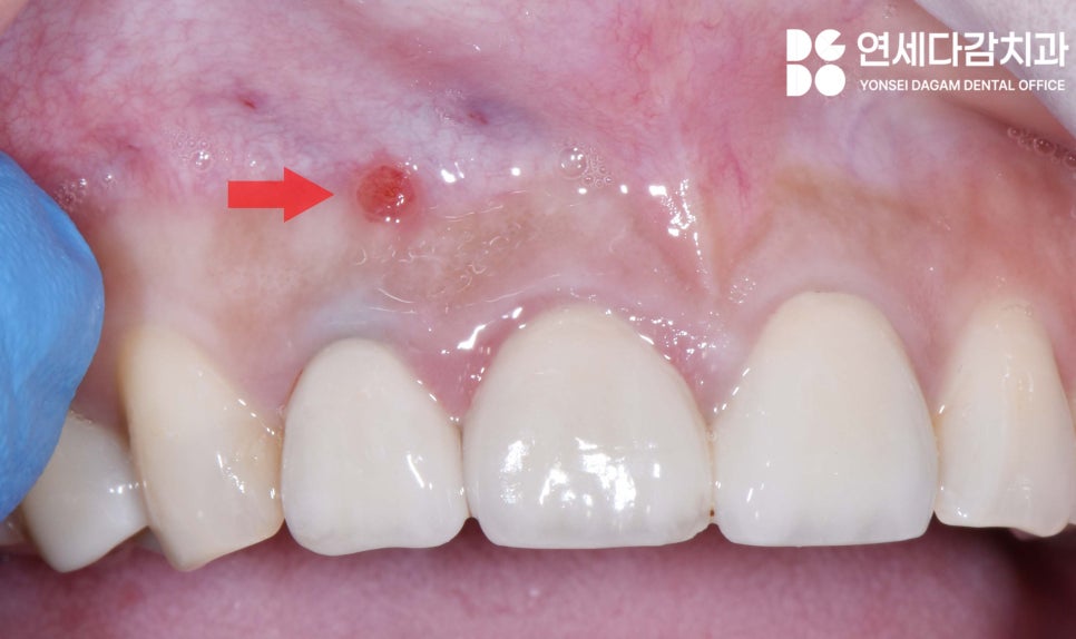 치아 발치를 피하기 위한 마지막 수단 MTA 이용한 가락동 치과 치근단 절제술 과정 살펴봅시다. 관련 이미지 2