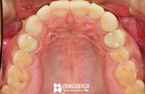 마모로 인한 치아 교모증 문정동 치과 에서 원인과 크라운 치료 방법 알려드리겠습니다. 관련 이미지 9