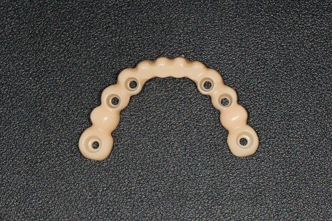 Temporary Teeth After Implants in Songpa-dong: Why They Can Be Provided Quickly image 8
