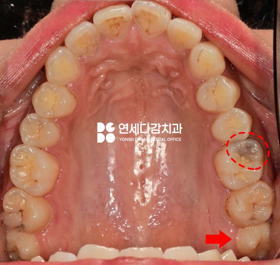 거여역 치과 공포증 수면마취 (의식하진정) 통해 매복 사랑니 발치 및 충치 치료 극복할 수 있습니다. 관련 이미지 3