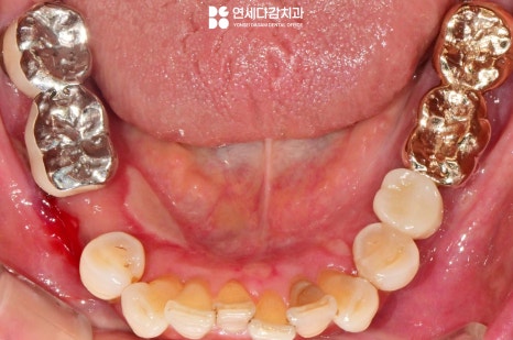 잇몸이 붓고 피나고 냄새날 때 송파역 치과 구강암 증상과 비슷한 급성 궤양성 치은염 (ANUG) 잇몸치료 통한 치주질환 개선 관련 이미지 8