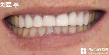 하얀 치아가 가져오는 인상의 변화 오금동 치과 교정 없이 최소삭제 라미네이트 심미치료 통해 치열 및 누렁니 개선 관련 이미지 9