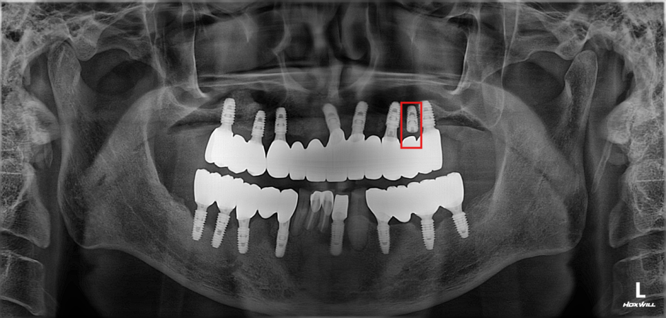 Munjeong-dong Full-Mouth Dental Implants: Why Did the Patient’s Appearance Change After Simply Replacing the Teeth? image 5