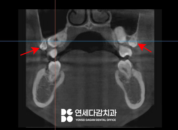 매복 사랑니 옆에 또 다른 치아 이것은 무엇일까요 송파구 가락동 치과 에서 알려드리겠습니다. 관련 이미지 4