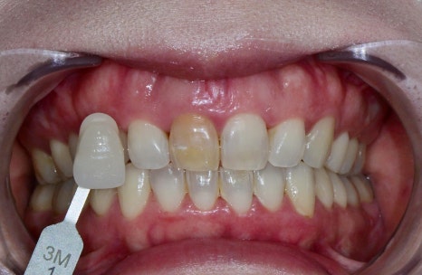 Geoyeo-dong Dental Clinic: Case of Internal Bleaching for a Discolored Front Tooth After Trauma image 5