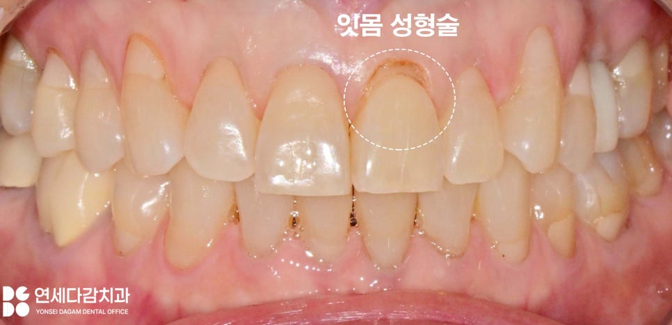 누런이 미백 안 해도 하얀이 원할 때 송파동 치과 최소삭제 라미네이트 과정에서 잇몸 치은 성형술 필요한 이유 관련 이미지 3