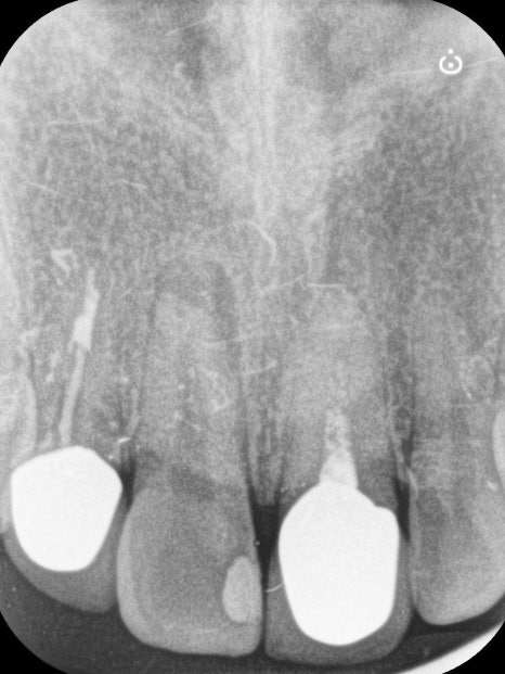 Macheon-dong Dental Clinic: Why Treating Root Inflammation Comes First Before an Anterior Crown image 3