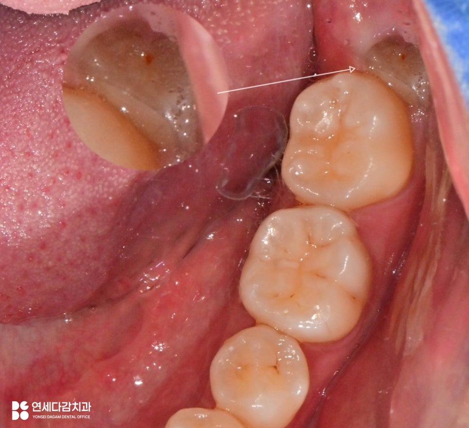 오금역 치과 후방 경사 부분 매복 사랑니, 조기 진단과 안전한 치료를 위한 가이드 관련 이미지 1