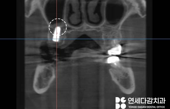 임플란트 재수술 가락동 치과 정밀한 분석과 전략적 접근 통한 치유 과정 관련 이미지 6