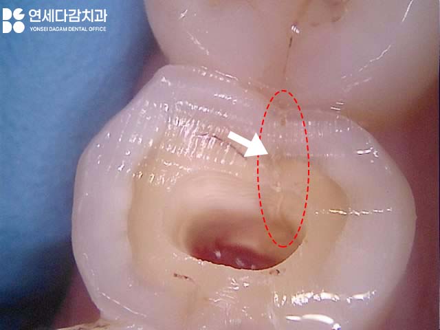 두통까지 아픈 어금니 치아 통증 송파역 치과 금간치아 신경치료 후 크라운 꼭 씌워야 되는 이유 관련 이미지 3