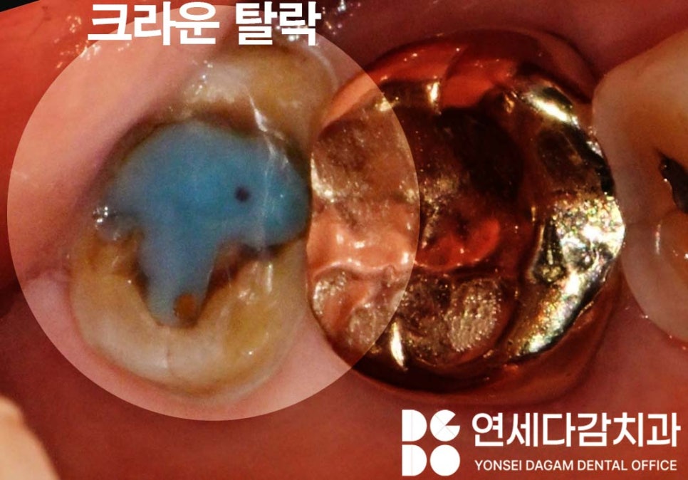 크라운 빠졌을 때 다시 붙일 수 있을까 문정동 치과 구강 스캐너 통한 보철 제작 관련 이미지 2
