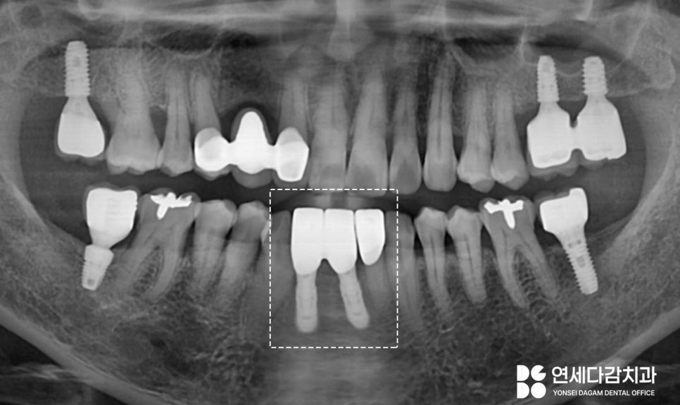 유독 까다로운 수술 부위가 있다? 오금역 치과 브릿지에서 임플란트 전환 과정 관련 이미지 8