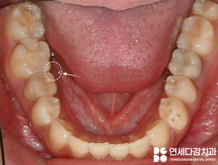 매복과잉치 를 발치할 때 CT 촬영이 필요한 이유? 연세다감치과 의학 정보 전달 글 관련 이미지 3