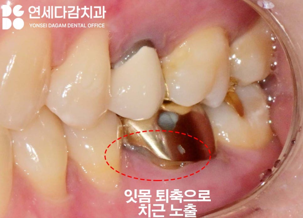 거여역 치과 미다졸람 수면마취 의식하진정법 임플란트 수술 말고 스케일링 크라운 치료 과정에서도 쓰이는 이유 관련 이미지 2
