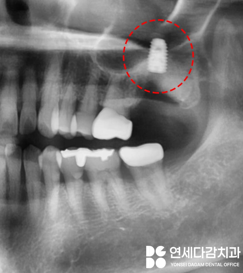 심한 염증으로 특이한 곳에 위치한 매복 사랑니 송파역 치과 에서 임플란트 수술과 함께 안전한 발치 했습니다. (feat. 상악동 천공 폐쇄술 ) 관련 이미지 6