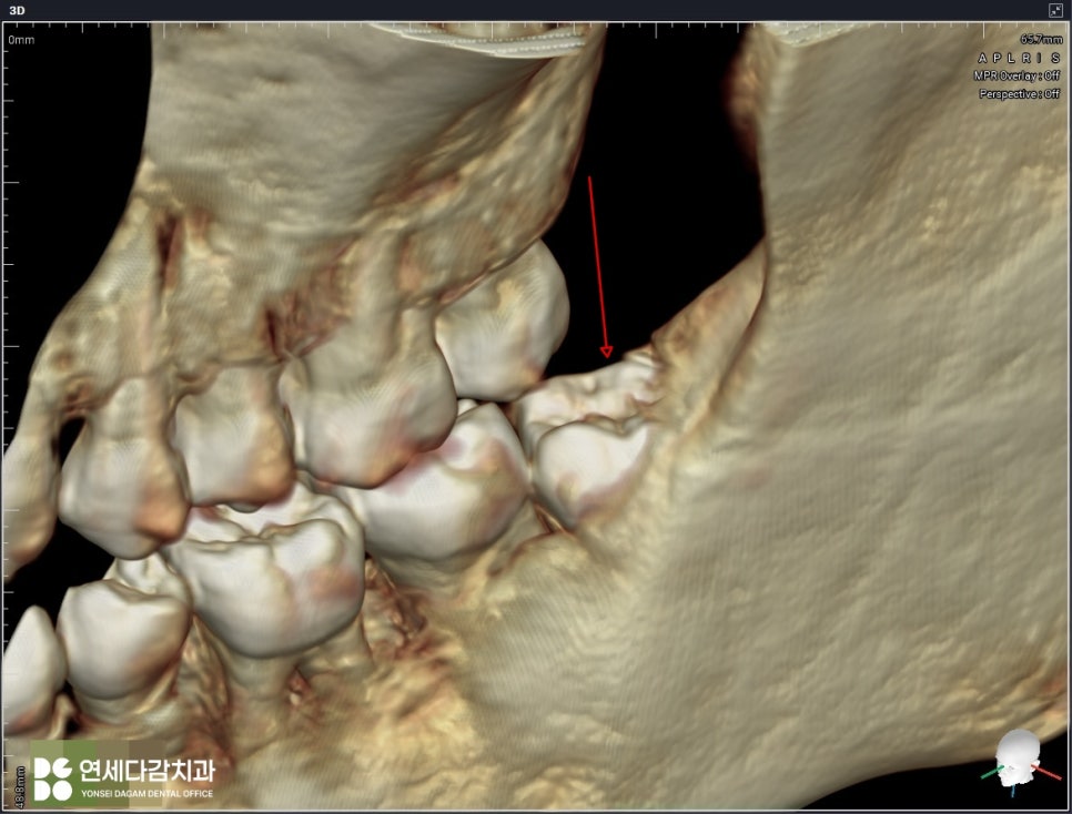 오금역 치과 후방 경사 부분 매복 사랑니, 조기 진단과 안전한 치료를 위한 가이드 관련 이미지 4