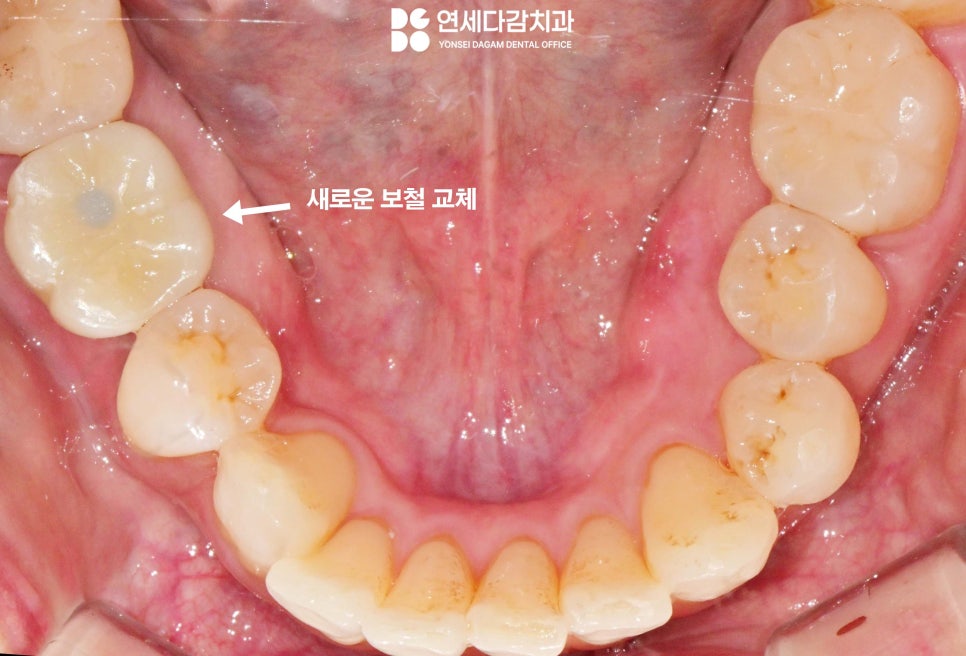 임플란트 빠짐 또는 흔들림 거여역 치과 나사 부러지고 빠졌을 때 재수술 없이 보철 크라운 교체할 수 있는 방법 관련 이미지 10