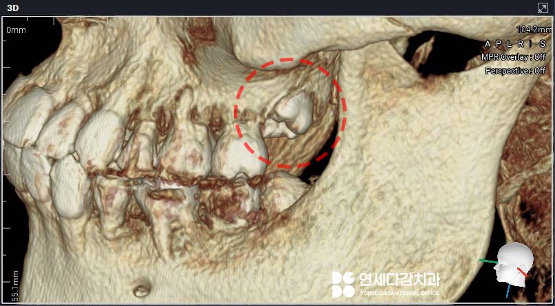 매복 사랑니 발치 시 관련 이미지 4