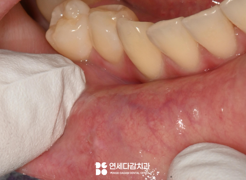 입안에 혹이 느껴진다면 외상성 섬유종 의심해 볼 수 있습니다 개롱역 치과 에서 알려드리는 원인과 치료방법 관련 이미지 3