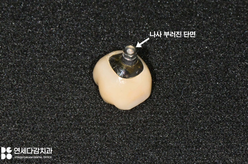 임플란트 빠짐 또는 흔들림 거여역 치과 나사 부러지고 빠졌을 때 재수술 없이 보철 크라운 교체할 수 있는 방법 관련 이미지 4