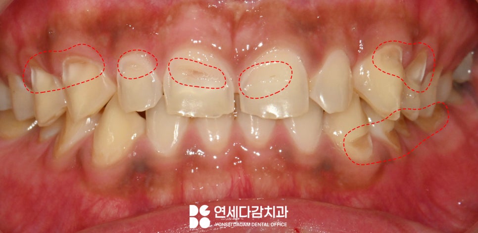마모로 인한 치아 교모증 문정동 치과 에서 원인과 크라운 치료 방법 알려드리겠습니다. 관련 이미지 1