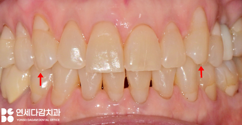 누런이 미백 안 해도 하얀이 원할 때 송파동 치과 최소삭제 라미네이트 과정에서 잇몸 치은 성형술 필요한 이유 관련 이미지 2