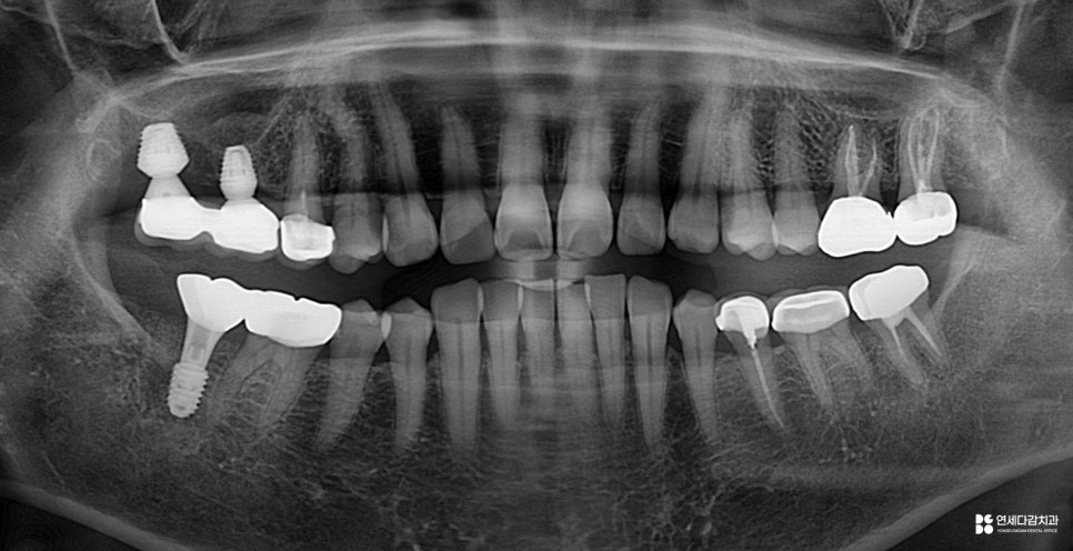 개롱역치과 아프기 전에 발견해야 되는 이유 인접면 충치 치료 관련 이미지 9
