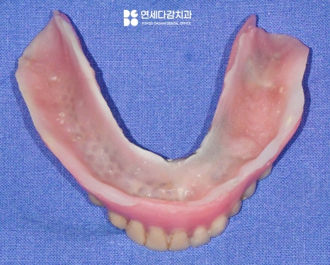 항암 치료 전 발치 필요할 때 기존 부분틀니 송파동 치과 에서 보철 수정 후 임시로 완전틀니 만든 이유 관련 이미지 10