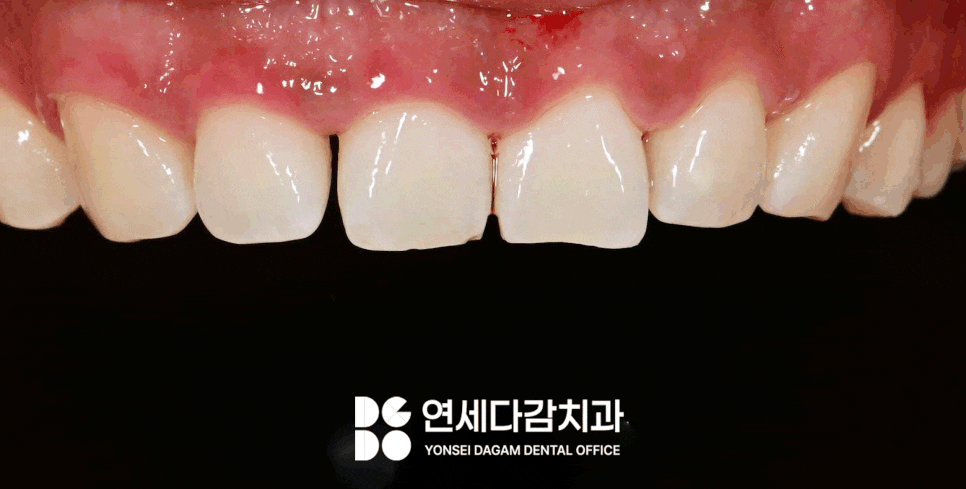 연세다감치과 심미 치료 무삭제 라미네이트 통해 자신감 있는 미소를 되찾는 여정 관련 이미지 8