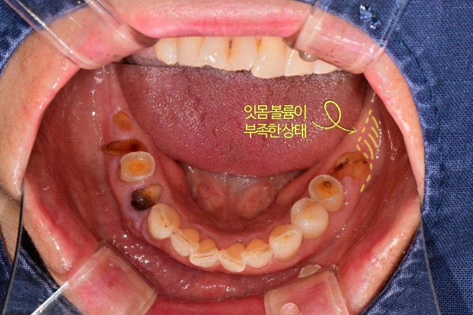 Munjeong-dong Dental Clinic, Bone Graft Implant Process&middot; What If You’ve Lost a Molar? image 3