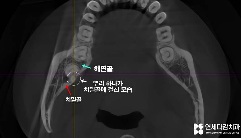 거여동 치과 매복 사랑니 발치 후 치아 뿌리 조각 부러짐 잔존치근 일부러 남겨두는 이유 관련 이미지 5