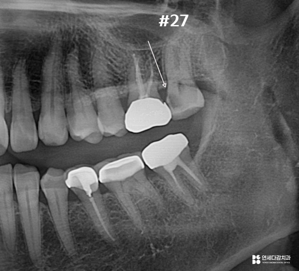 개롱역치과 아프기 전에 발견해야 되는 이유 인접면 충치 치료 관련 이미지 6