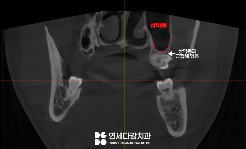 상악동 또는 신경 가까운 누워있는 매복 사랑니 가락시장역 치과 단순 발치를 위한 필수 CT 분석 과정 관련 이미지 5