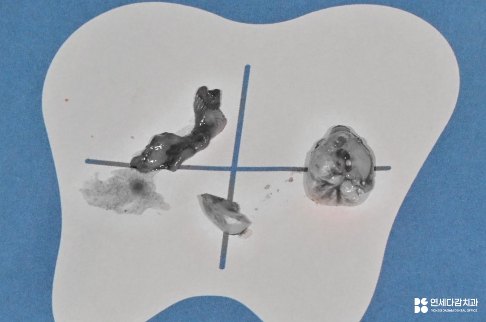 가락동 치과 교정 치료 전 사랑니 발치 꼭 필요할까? - 미성숙 매복케이스로 알아보는 과정 관련 이미지 8
