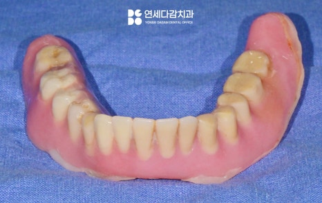 항암 치료 전 발치 필요할 때 기존 부분틀니 송파동 치과 에서 보철 수정 후 임시로 완전틀니 만든 이유 관련 이미지 8
