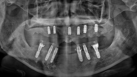 Temporary Teeth After Implants in Songpa-dong: Why They Can Be Provided Quickly image 10
