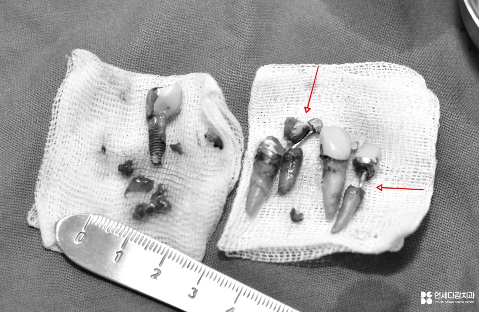 문정동 치과 수면마취(의식하진정법)으로 진행되는 임플란트 수술 관련 이미지 4