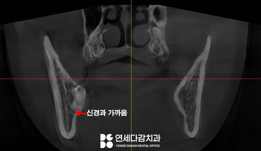 거여동 치과 매복 사랑니 발치 후 치아 뿌리 조각 부러짐 잔존치근 일부러 남겨두는 이유 관련 이미지 3