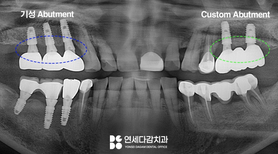 문정역 치과 임플란트 오래 사용하기 위해서 지대주 (어버트먼트) 보철 종류 기성 및 커스텀 지대주 (abutment) 차이 알고 받아야 되는 이유 관련 이미지 5