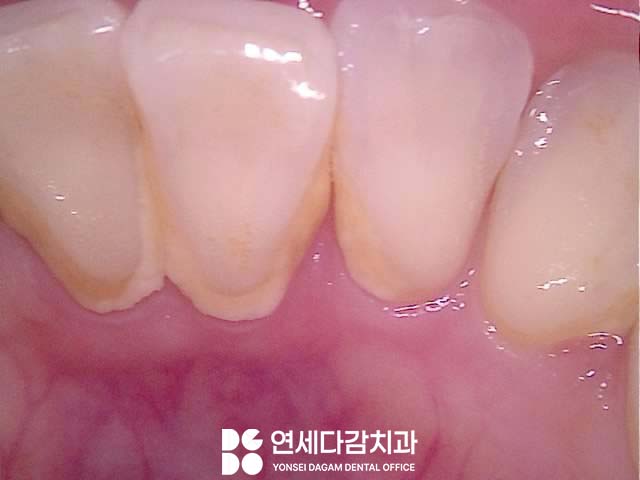 이시림 원인 치경부 마모증 치료할 때 쓰이는 문정역 치과 레진과 G.I 재료의 특성 관련 이미지 2