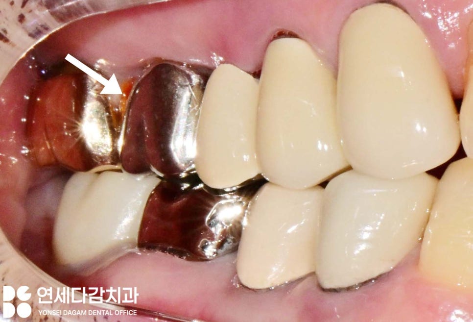 크라운 또는 브릿지 같은 보철 치료 했던 부위에 충치 또는 잇몸질환 생기는 이유 가락시장역 치과 치근우식 생겼을 때 발치 후 임플란트 관련 이미지 8