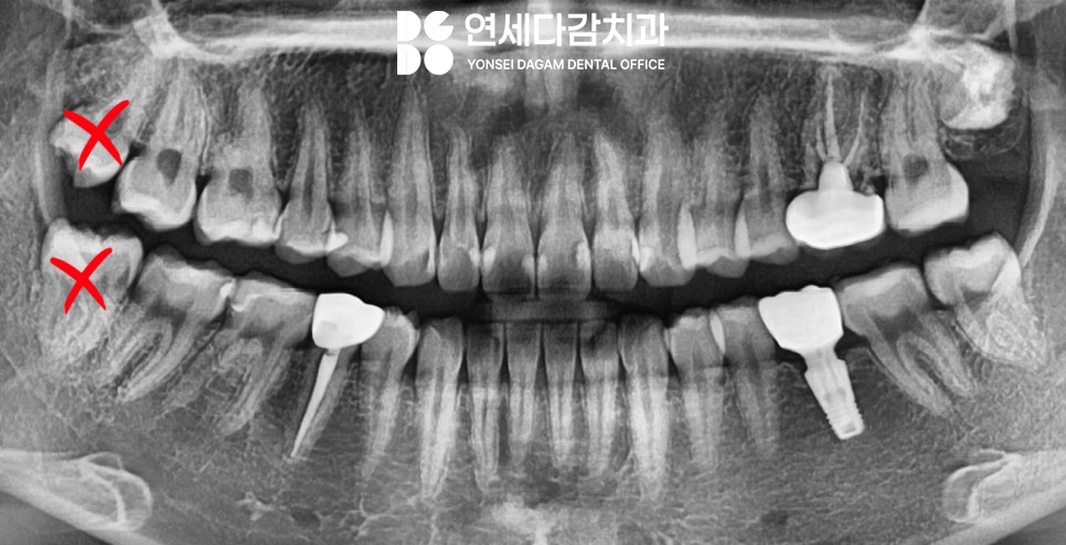 매복과잉치 를 발치할 때 CT 촬영이 필요한 이유? 연세다감치과 의학 정보 전달 글 관련 이미지 10