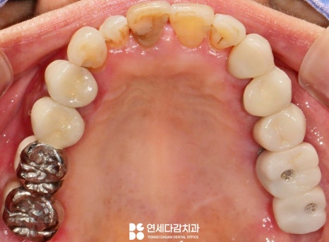 잇몸이 붓고 피나고 냄새날 때 송파역 치과 구강암 증상과 비슷한 급성 궤양성 치은염 (ANUG) 잇몸치료 통한 치주질환 개선 관련 이미지 7