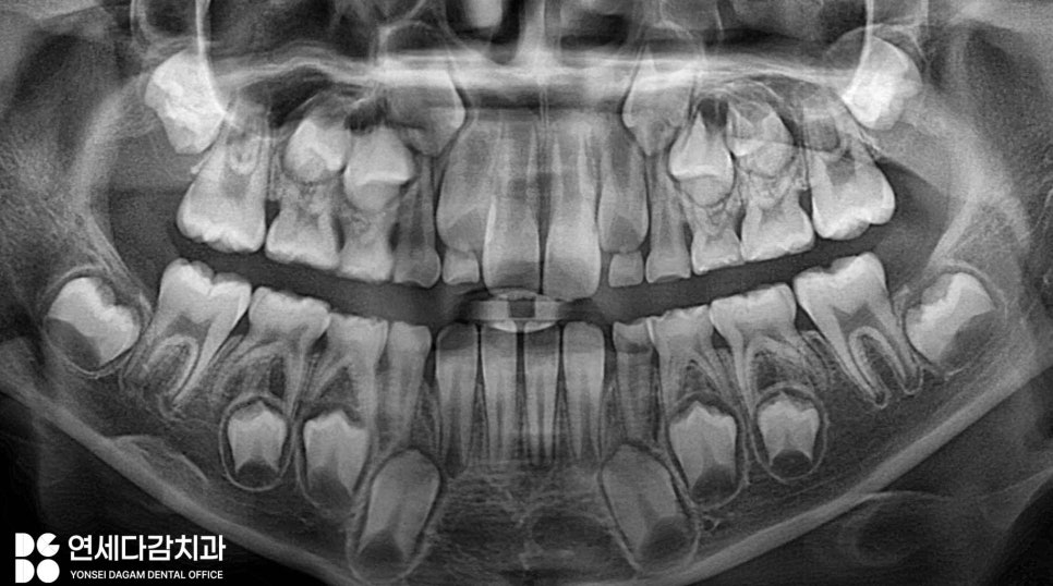 오금동 치과 충치 레진 치료 보험 혜택받을 수 있을까 우리 아이 구강 건강을 위한 치아 우식 예방법 관련 이미지 1