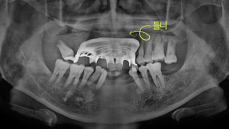 Temporary Teeth After Implants in Songpa-dong: Why They Can Be Provided Quickly image 1