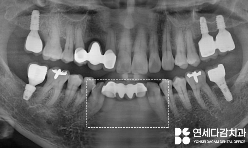 유독 까다로운 수술 부위가 있다? 오금역 치과 브릿지에서 임플란트 전환 과정 관련 이미지 1